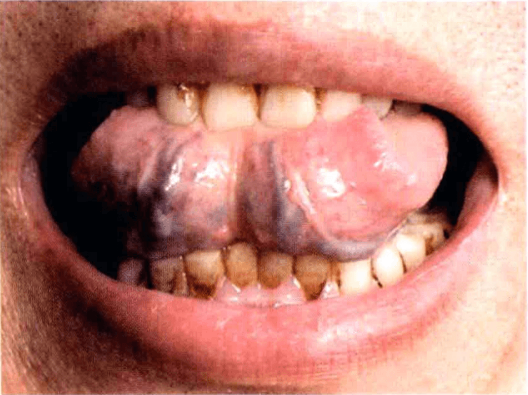 Schmerzen Zunge Schluckbeschwerden