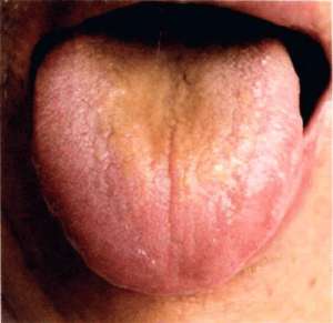 Zunge geschwollen